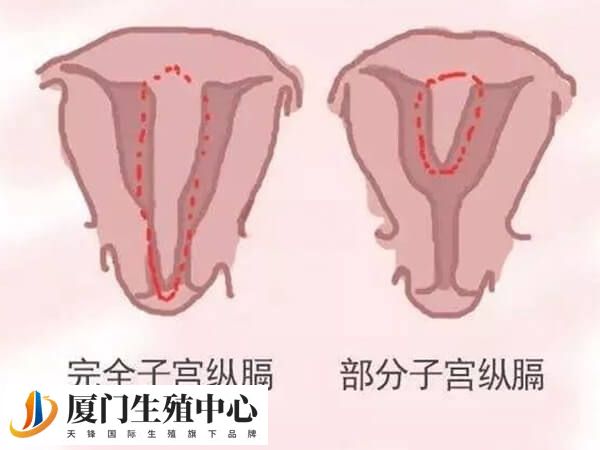 完全和不完全纵隔子宫的危害都较大