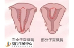 纵隔子宫的危害除了反复流产还有什么？